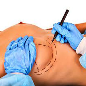 breast surgery